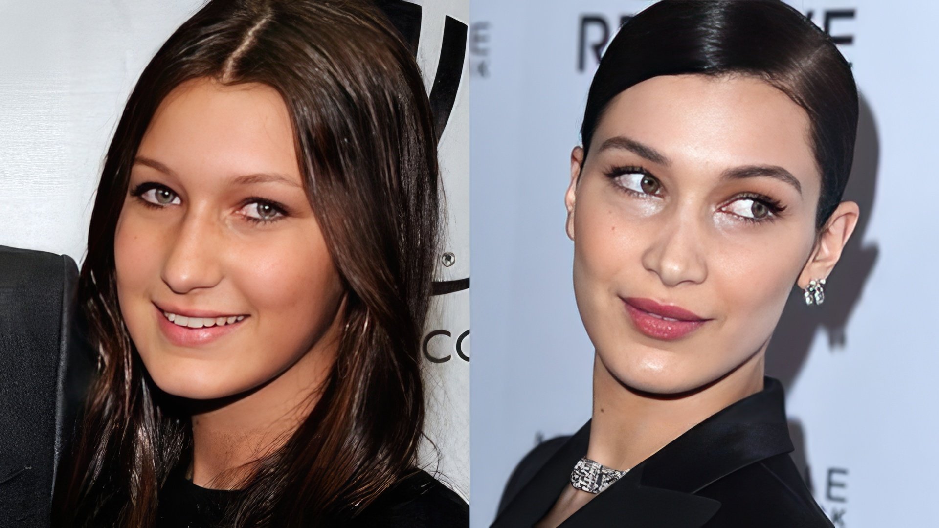 Bella Hadid antes y después de la cirugía plástica